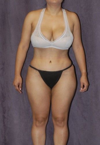 Liposuction Before & After