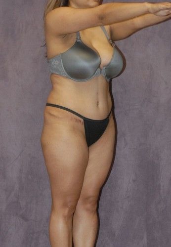 Liposuction Before & After