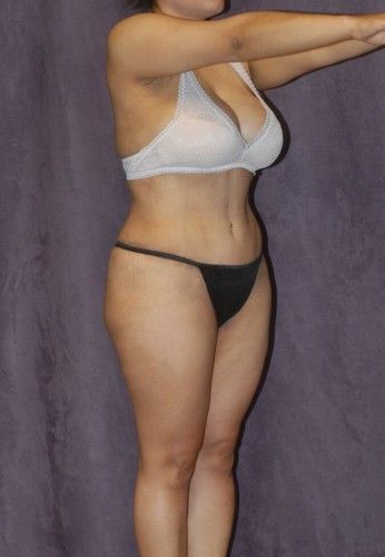 Liposuction Before & After