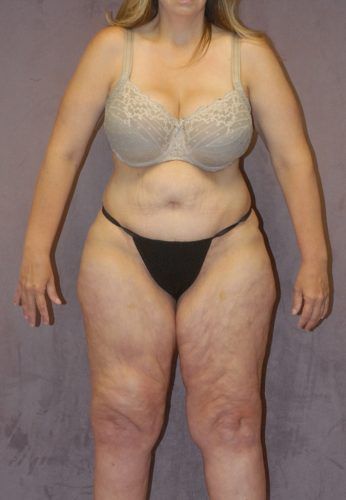 Liposuction Before & After