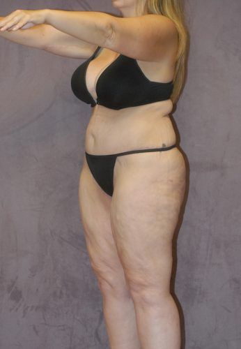 Liposuction Before & After