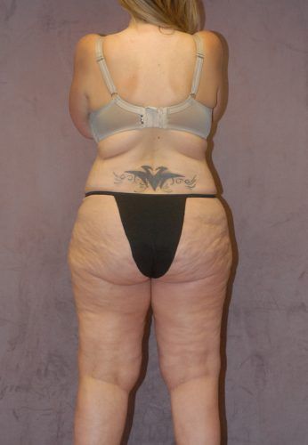 Liposuction Before & After