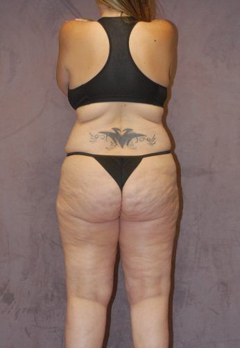 Liposuction Before & After