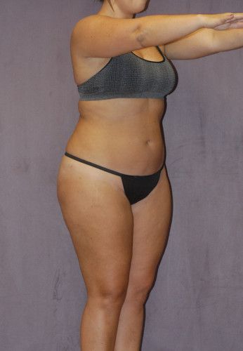 Liposuction Before & After