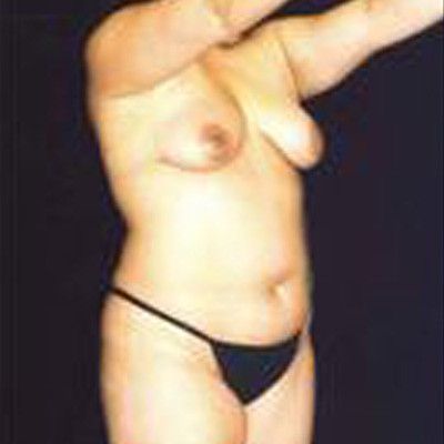 Liposuction Before & After
