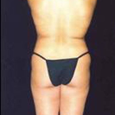 Liposuction Before & After