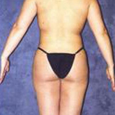 Liposuction Before & After