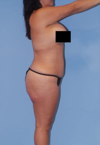Liposuction Before & After