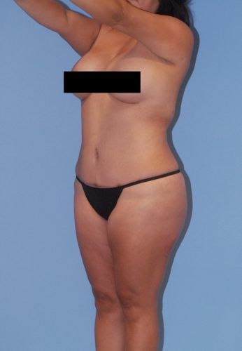 Liposuction Before & After