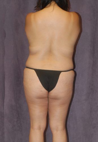Liposuction Before & After