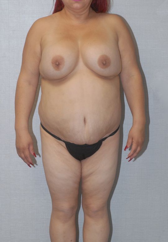 Liposuction Before & After