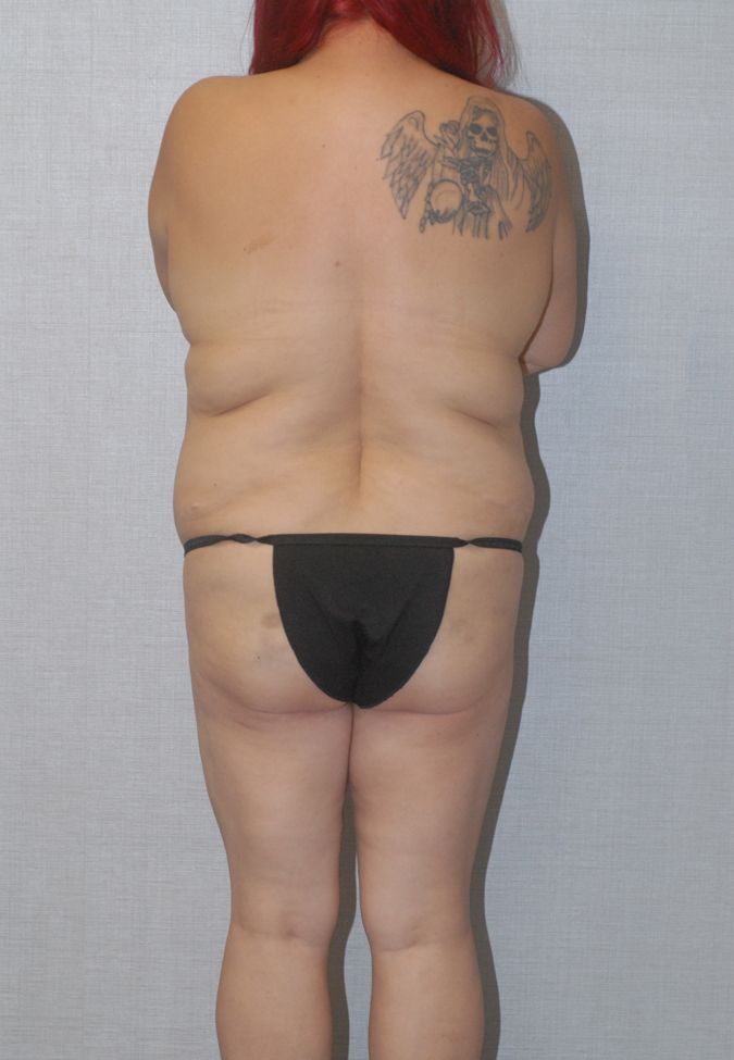 Liposuction Before & After