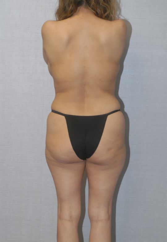 Liposuction Before & After