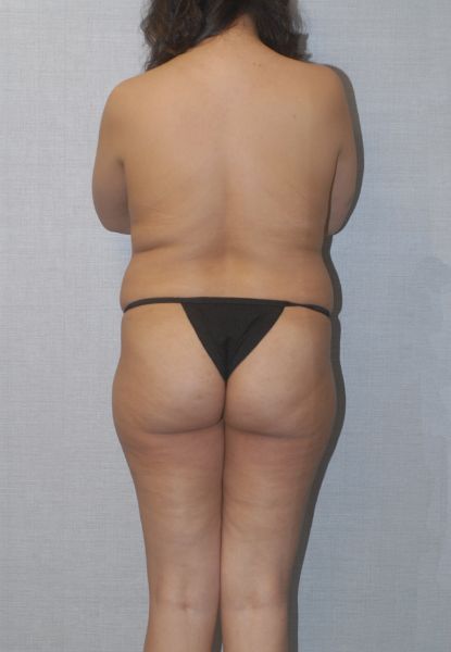 Liposuction Before & After