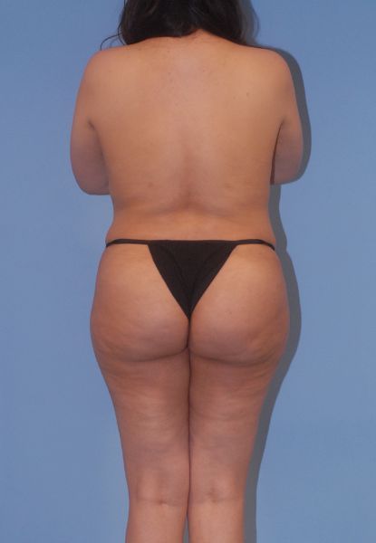 Liposuction Before & After