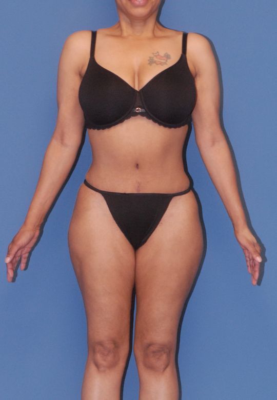 Liposuction Before & After