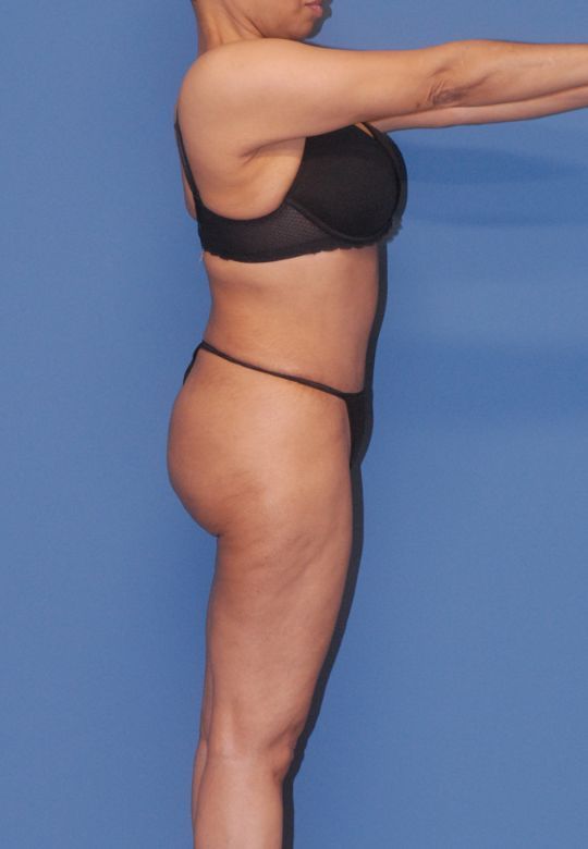 Liposuction Before & After