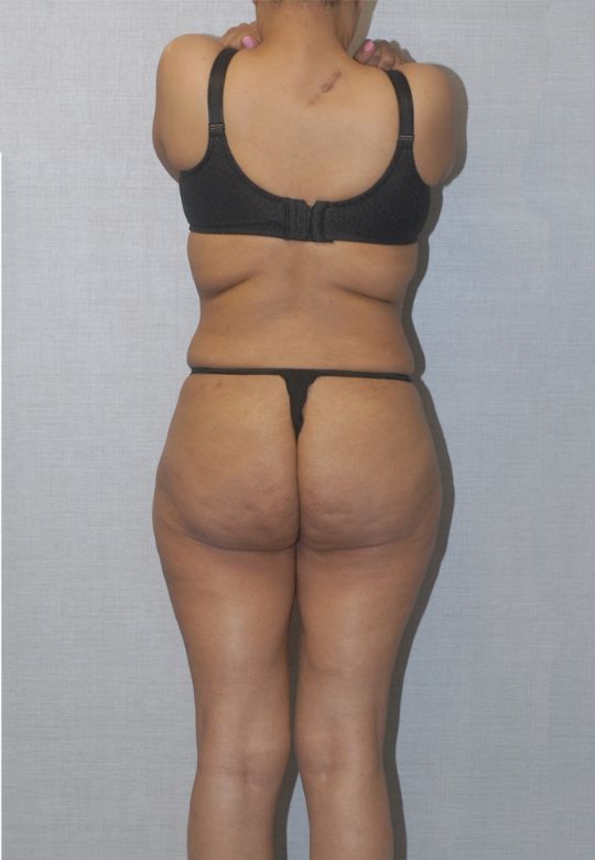 Liposuction Before & After