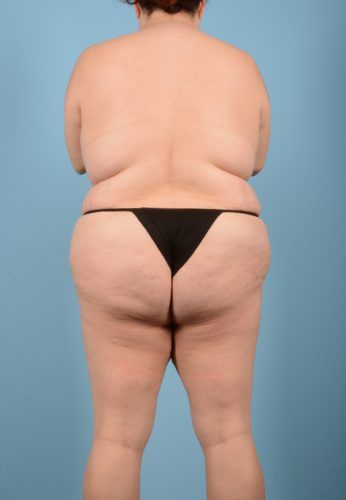 Liposuction Before & After