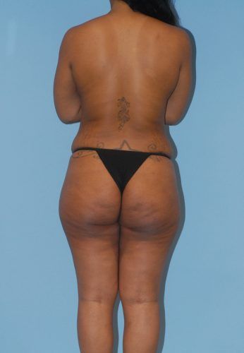 Liposuction Before & After
