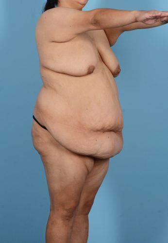 Liposuction Before & After