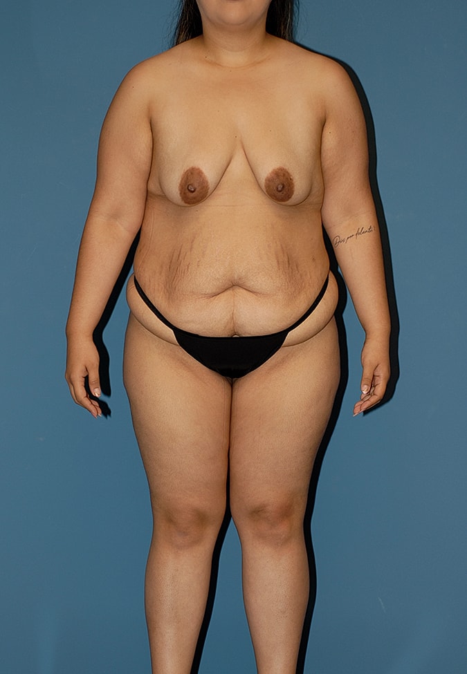 Liposuction Before & After
