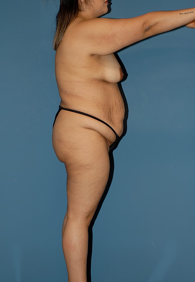 Liposuction Before & After