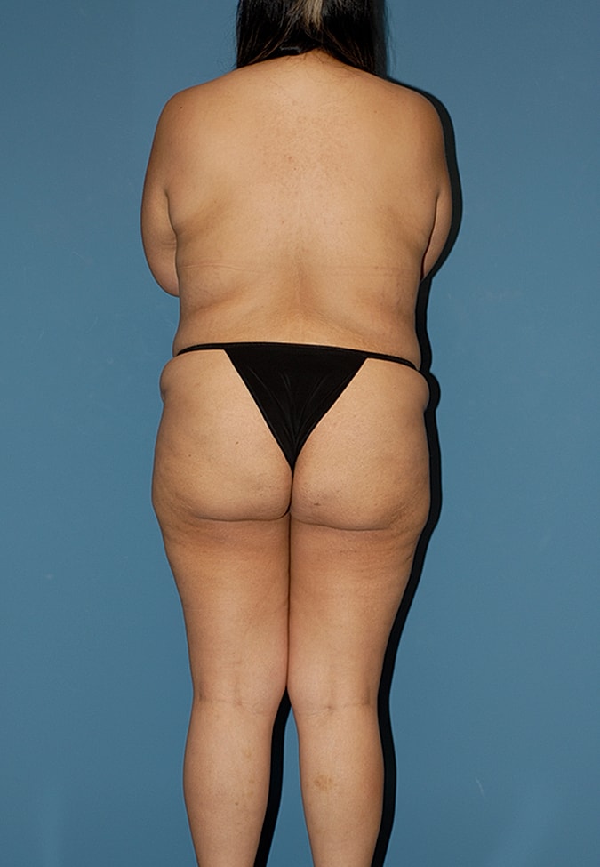Liposuction Before & After