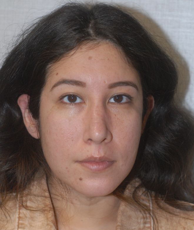 Chin Augmentation Before & After