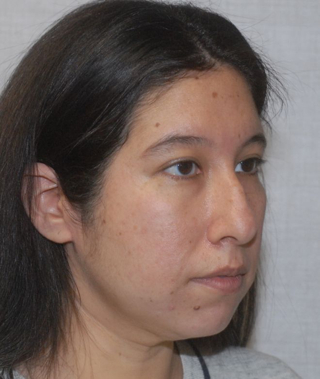 Chin Augmentation Before & After