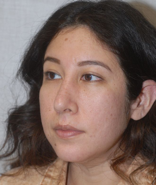 Chin Augmentation Before & After