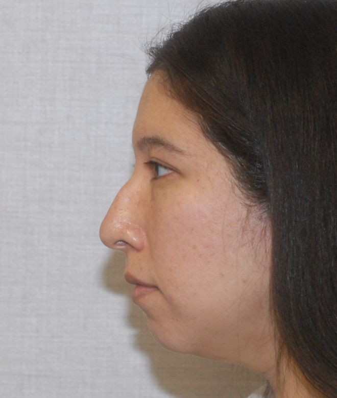 Chin Augmentation Before & After