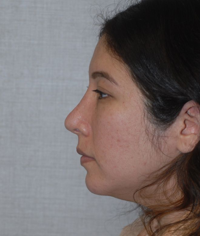 Chin Augmentation Before & After
