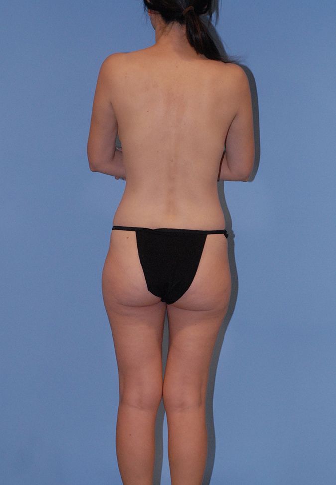 Breast Implant Exchange Before & After