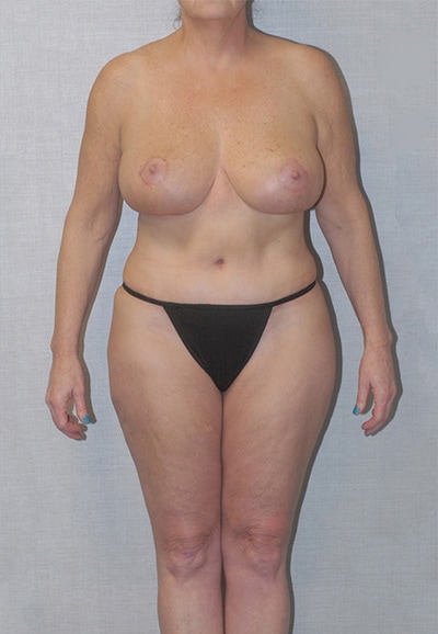Abdominoplasty Before & After Image