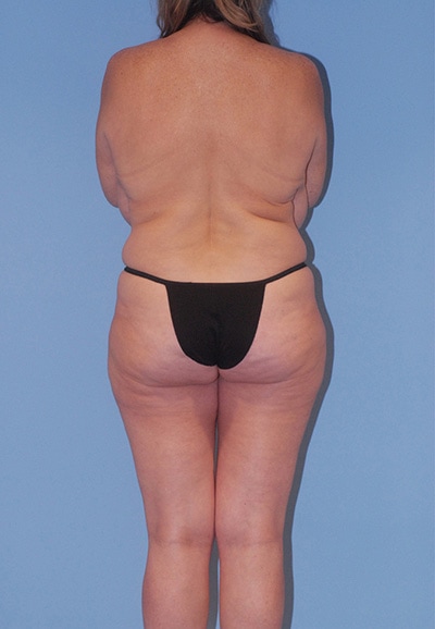 Abdominoplasty Before & After Image