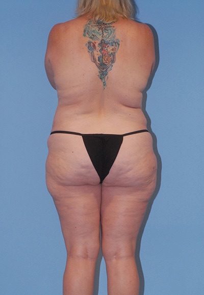 Abdominoplasty Before & After Image