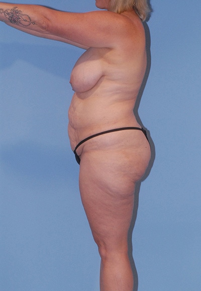 Abdominoplasty Before & After Image