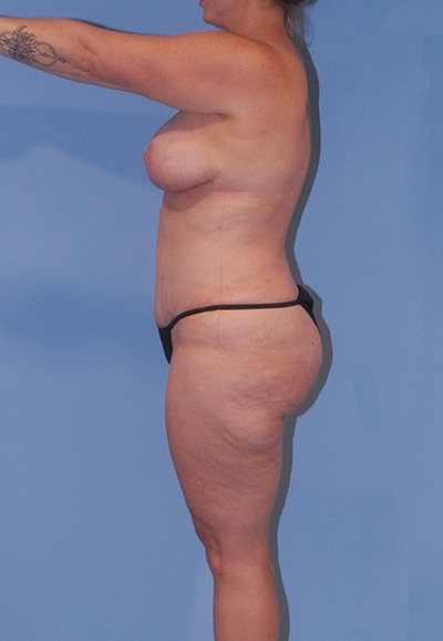 Abdominoplasty Before & After Image