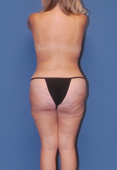 Abdominoplasty Before & After Image