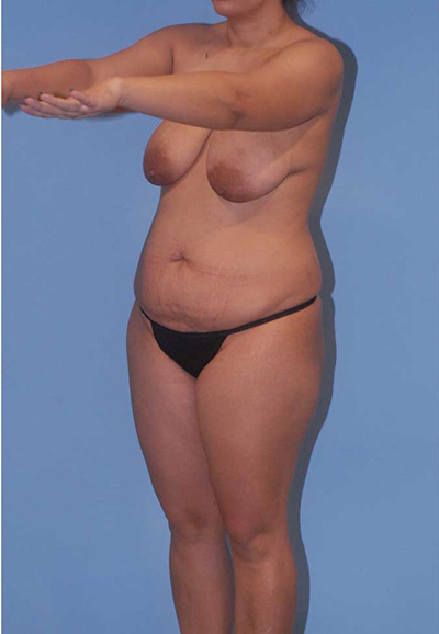 Abdominoplasty Before & After Image