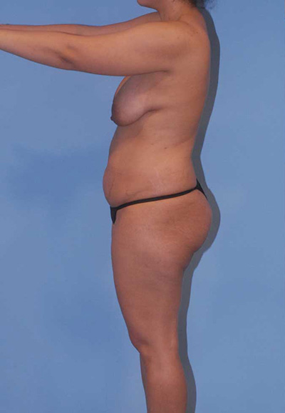 Abdominoplasty Before & After Image