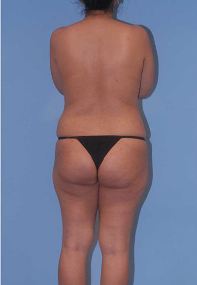 Abdominoplasty Before & After Image