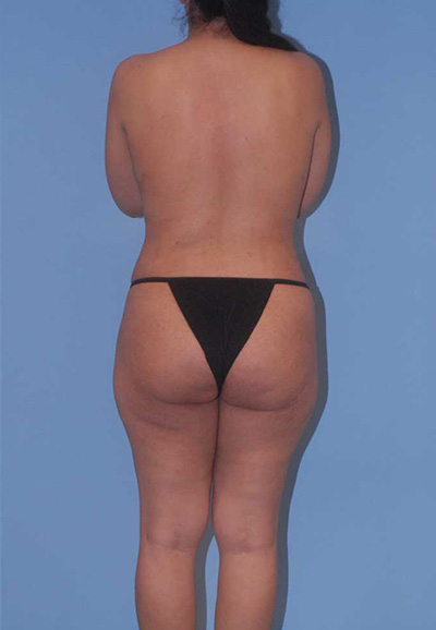 Abdominoplasty Before & After Image