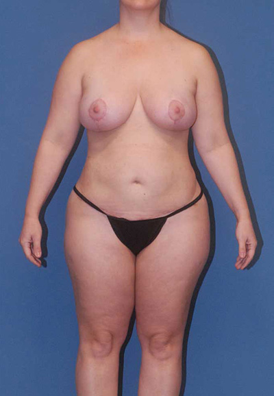 Abdominoplasty Before & After Image
