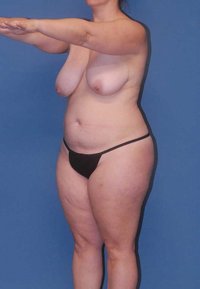 Abdominoplasty Before & After Image
