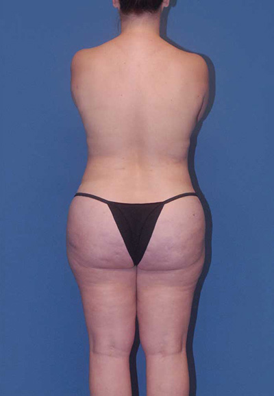 Abdominoplasty Before & After Image