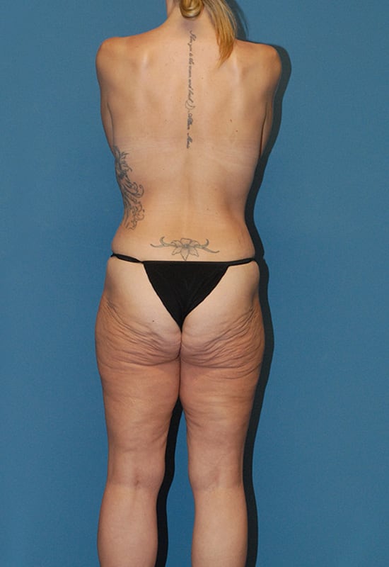 Abdominoplasty Before & After Image