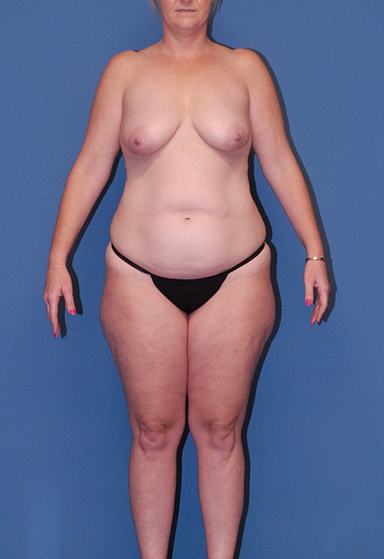 Abdominoplasty Before & After Image