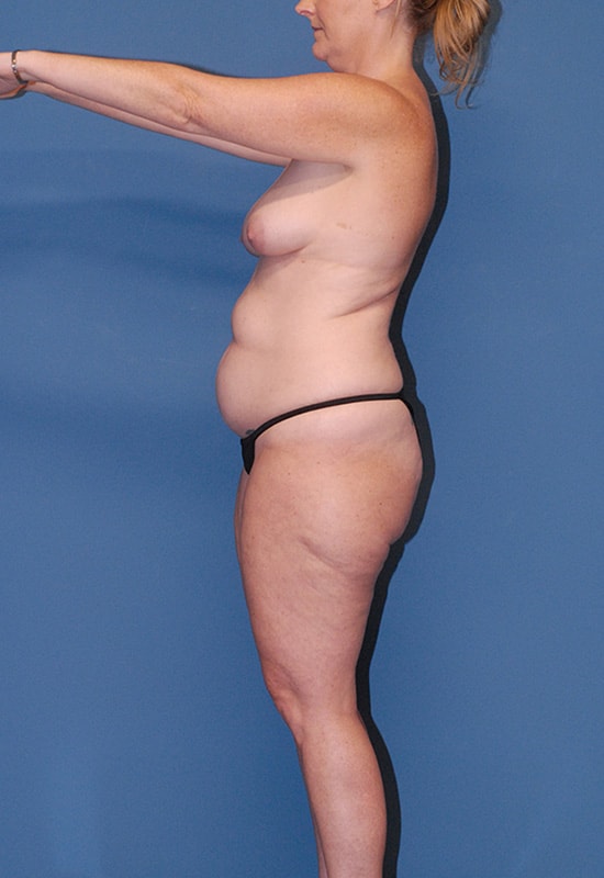 Abdominoplasty Before & After Image